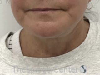 Neck Lift Before & After Gallery - Patient 157140046 - Image 4