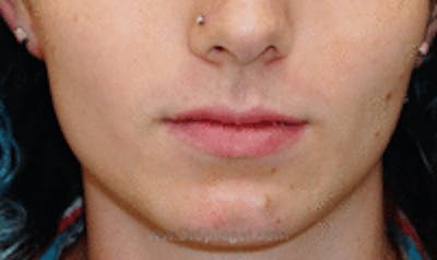 Mandible Contouring Before & After Gallery - Patient 157140045 - Image 1