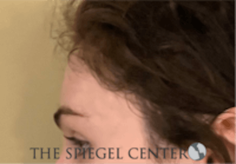 Forehead Contouring Before & After Gallery - Patient 157140043 - Image 4