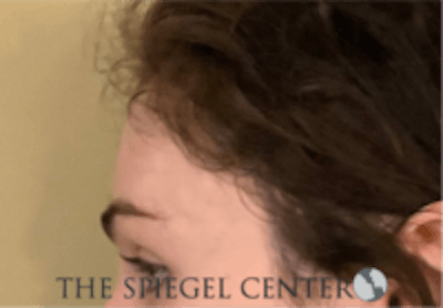 Forehead Contouring Before & After Gallery - Patient 157140043 - Image 4