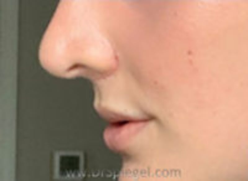 Lip Augmentation / Lip Implant / Lip Lift Before & After Gallery - Patient 157140044 - Image 4