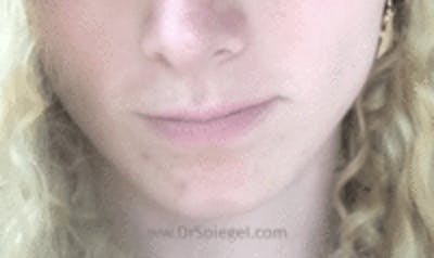 Mandible Contouring Before & After Gallery - Patient 157140045 - Image 2