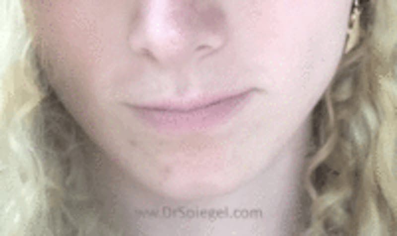 Mandible Contouring Before & After Gallery - Patient 157140045 - Image 2