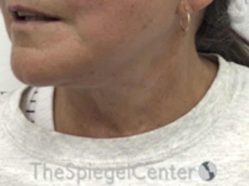 Neck Lift Before & After Gallery - Patient 157140046 - Image 2