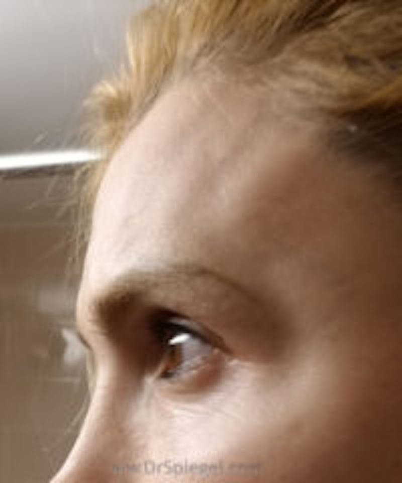 Browlift / Fox Eye Lift Before & After Gallery - Patient 157140048 - Image 1