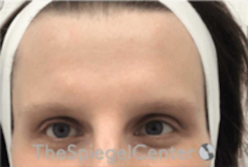 Forehead Contouring Before & After Gallery - Patient 157140050 - Image 1