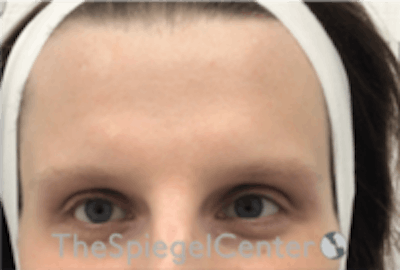 Forehead Contouring Before & After Gallery - Patient 157140050 - Image 1
