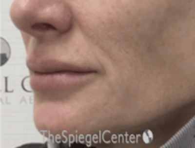 Lip Lift Before & After Gallery - Patient 157140052 - Image 3