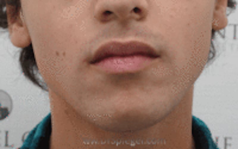 Mandible Contouring Before & After Gallery - Patient 157140049 - Image 1