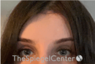 Forehead Contouring Before & After Gallery - Patient 157140050 - Image 2