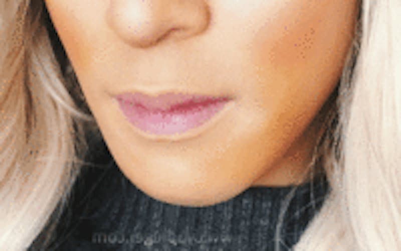 Mandible Contouring Before & After Gallery - Patient 157140049 - Image 2
