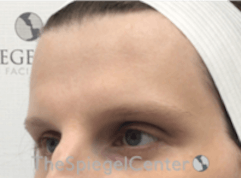 Forehead Contouring Before & After Gallery - Patient 157140050 - Image 3