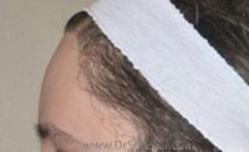Browlift / Fox Eye Lift Before & After Gallery - Patient 157140051 - Image 1
