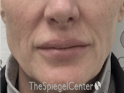 Lip Lift Before & After Gallery - Patient 157140052 - Image 1