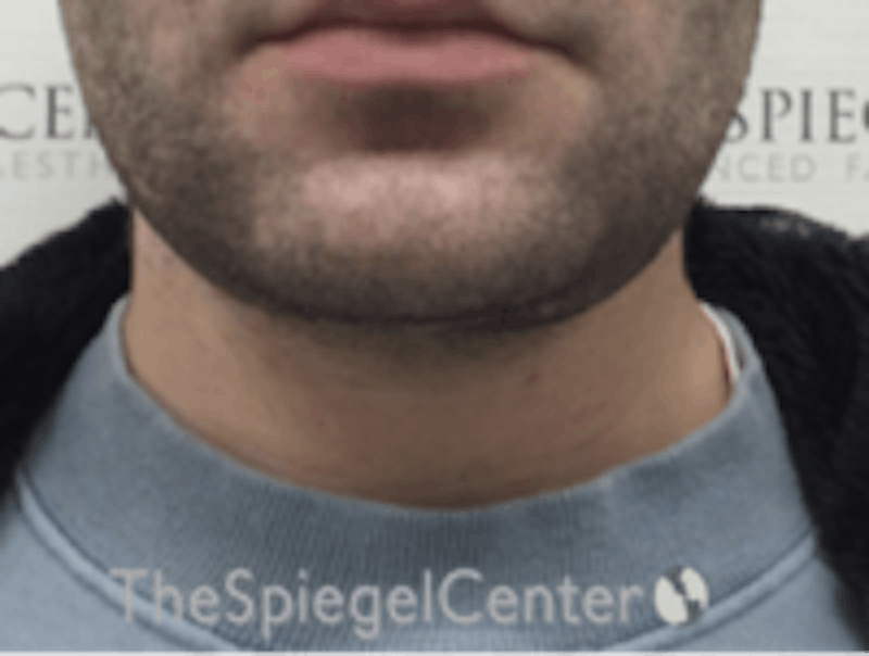 Neck Lift Before & After Gallery - Patient 157140055 - Image 4