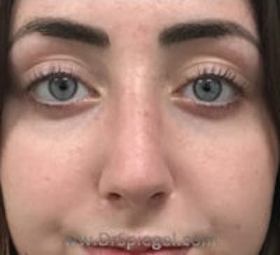 Rhinoplasty Before & After Gallery - Patient 157140056 - Image 4