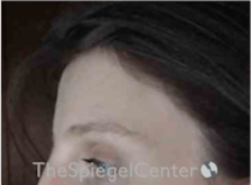 Forehead Contouring Before & After Gallery - Patient 157140050 - Image 4