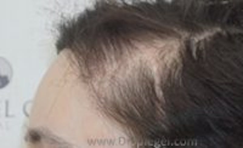 Browlift / Fox Eye Lift Before & After Gallery - Patient 157140051 - Image 2