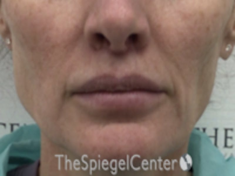 Lip Augmentation / Lip Implant / Lip Lift Before & After Gallery - Patient 157140052 - Image 2