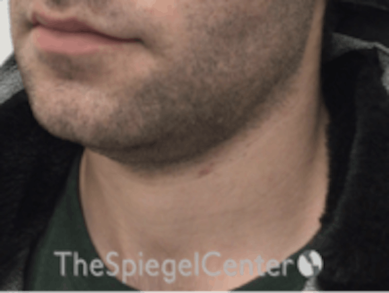 Neck Lift Before & After Gallery - Patient 157140055 - Image 1