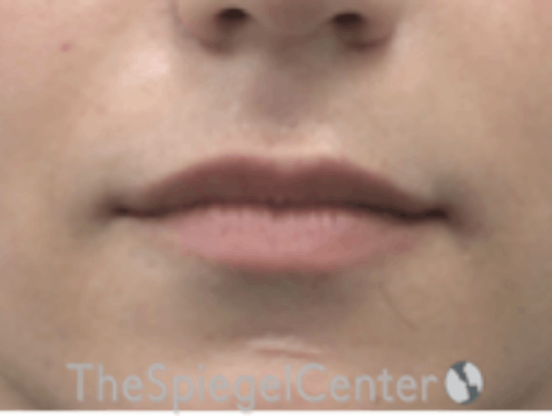 Lip Lift Before & After Gallery - Patient 157140067 - Image 1