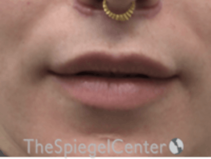Lip Lift Before & After Gallery - Patient 157140067 - Image 2