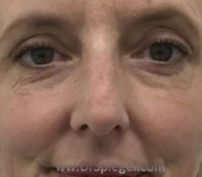 Rhinoplasty Before & After Gallery - Patient 157140069 - Image 3