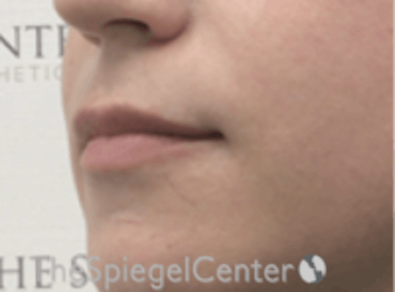 Lip Lift Before & After Gallery - Patient 157140067 - Image 3