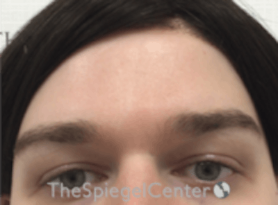 Forehead Contouring Before & After Gallery - Patient 157140075 - Image 1