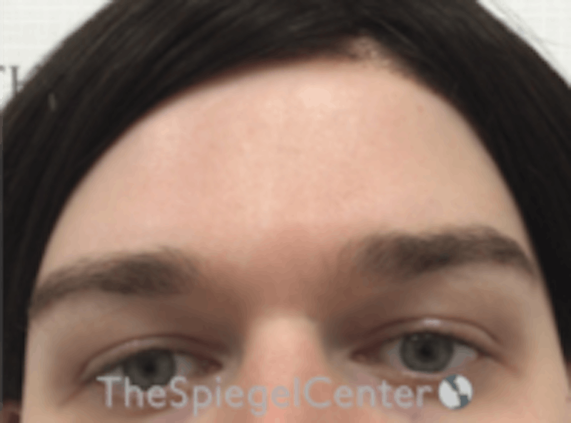Forehead Contouring Before & After Gallery - Patient 157140075 - Image 1