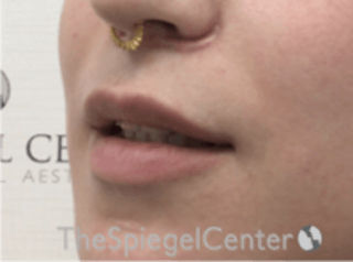 Lip Lift Before & After Gallery - Patient 157140067 - Image 4