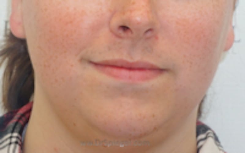 Mandible Contouring Before & After Gallery - Patient 157140073 - Image 1