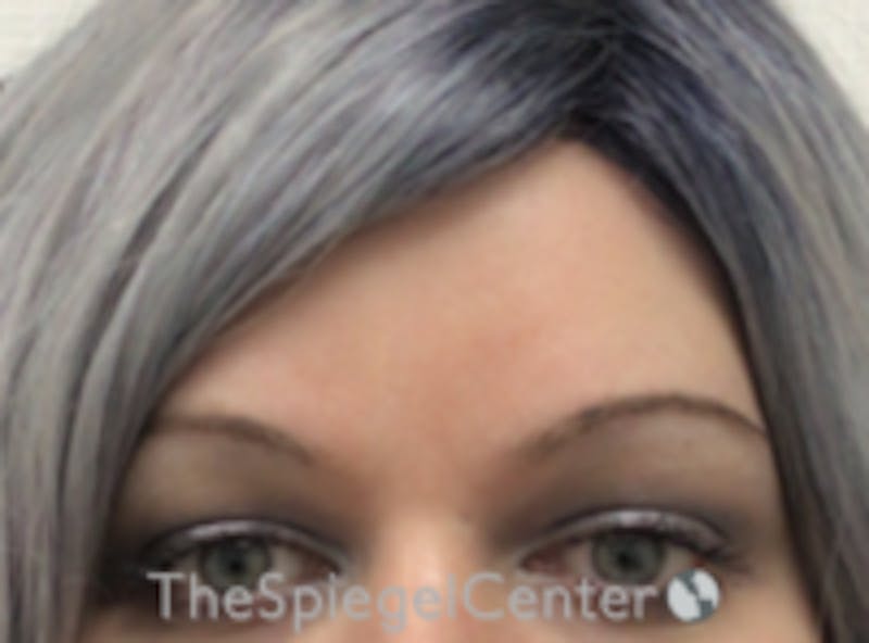 Forehead Contouring Before & After Gallery - Patient 157140075 - Image 2