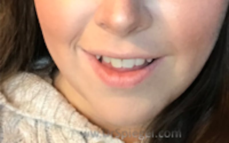 Mandible Contouring Before & After Gallery - Patient 157140073 - Image 2