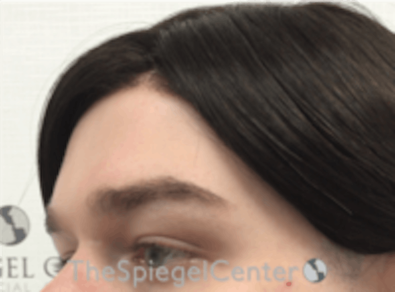 Forehead Contouring Before & After Gallery - Patient 157140075 - Image 3