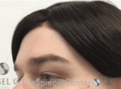 Forehead Contouring Before & After Gallery - Patient 157140075 - Image 3