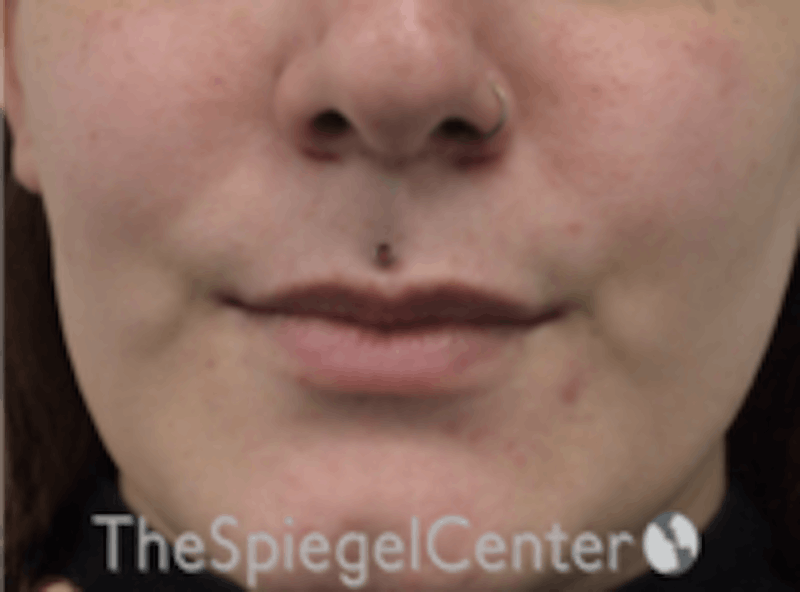 Lip Lift Before & After Gallery - Patient 157140080 - Image 1