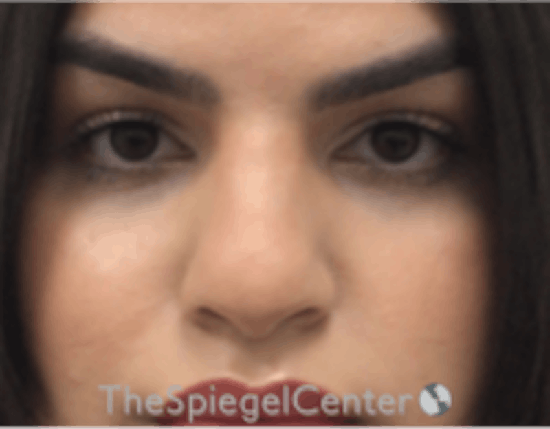 Rhinoplasty Before & After Gallery - Patient 157140081 - Image 3