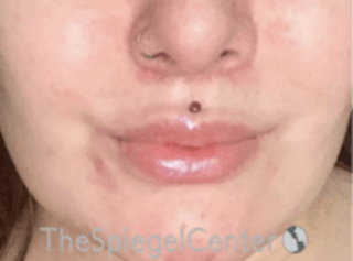Lip Lift Before & After Gallery - Patient 157140080 - Image 2