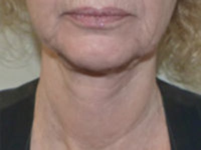 Neck Lift Before & After Gallery - Patient 157140082 - Image 4