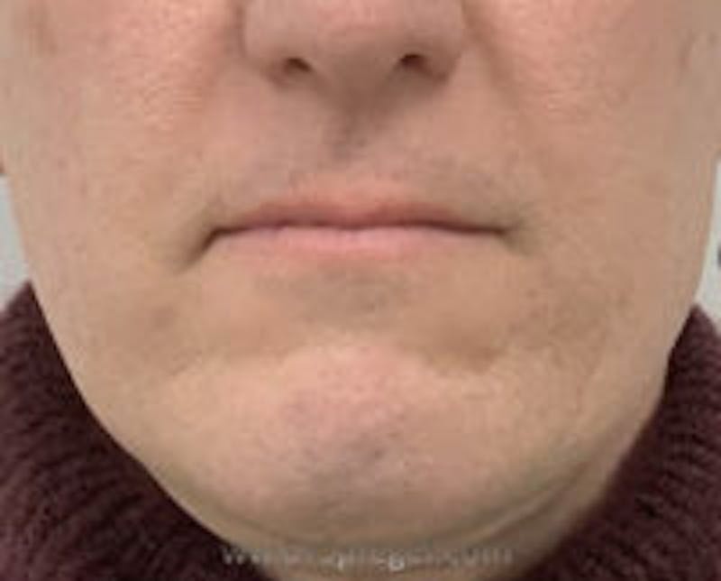 Mandible Contouring Before & After Gallery - Patient 157140077 - Image 1