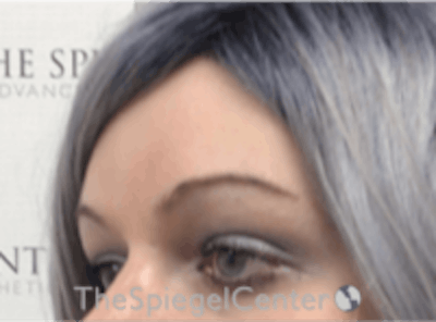 Forehead Contouring Before & After Gallery - Patient 157140075 - Image 4