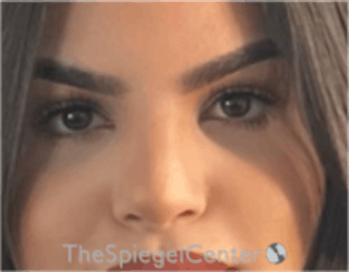 Rhinoplasty Before & After Gallery - Patient 157140081 - Image 4