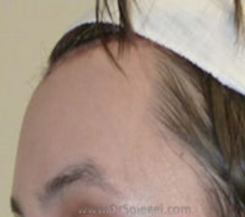Browlift / Fox Eye Lift Before & After Gallery - Patient 157140076 - Image 2