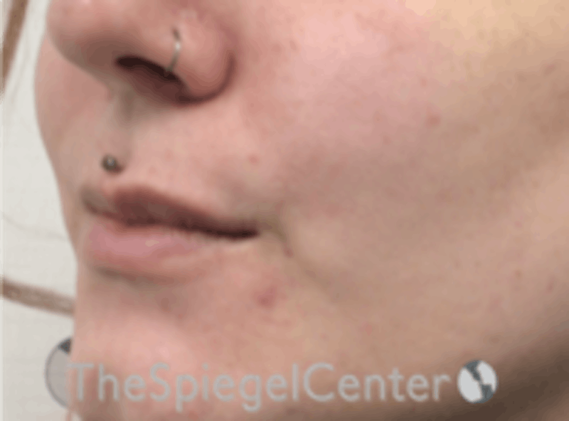 Lip Augmentation / Lip Implant / Lip Lift Before & After Gallery - Patient 157140080 - Image 3