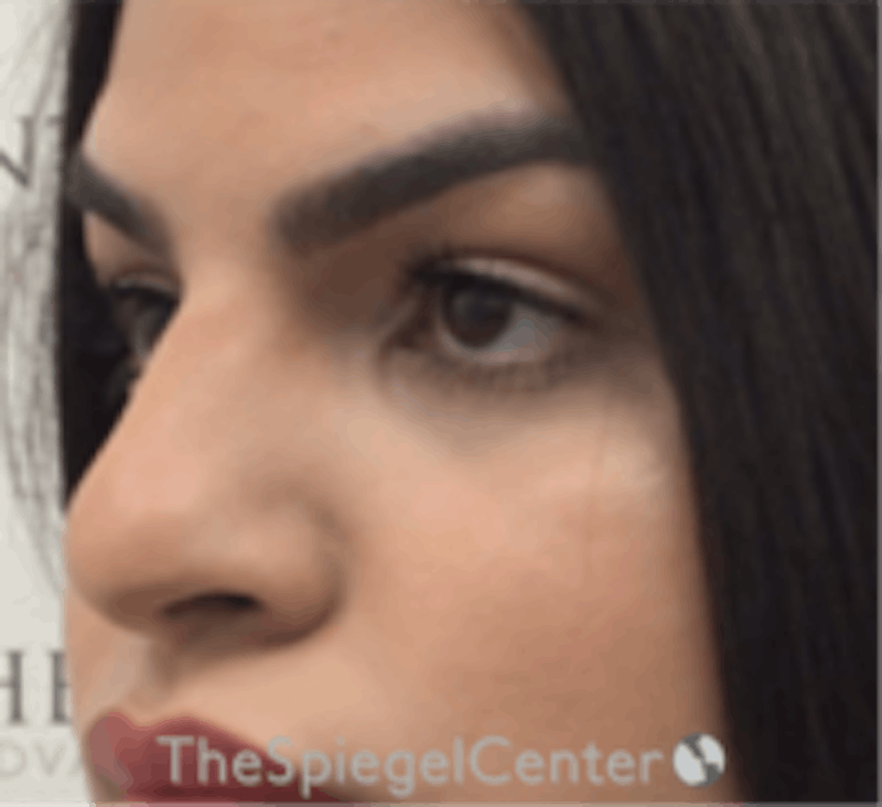 Rhinoplasty Before & After Gallery - Patient 157140081 - Image 1