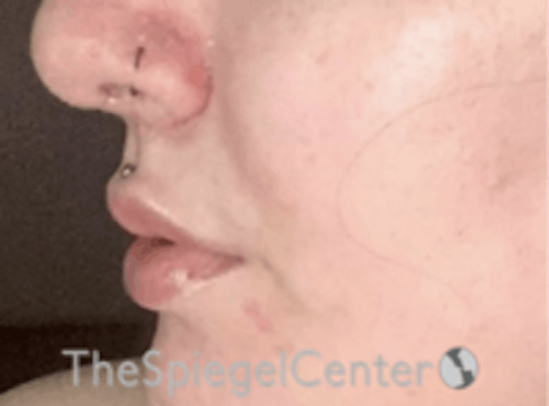 Lip Lift Before & After Gallery - Patient 157140080 - Image 4