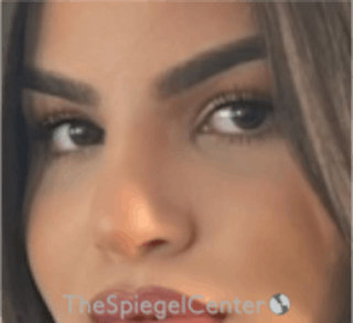 Rhinoplasty Before & After Gallery - Patient 157140081 - Image 2