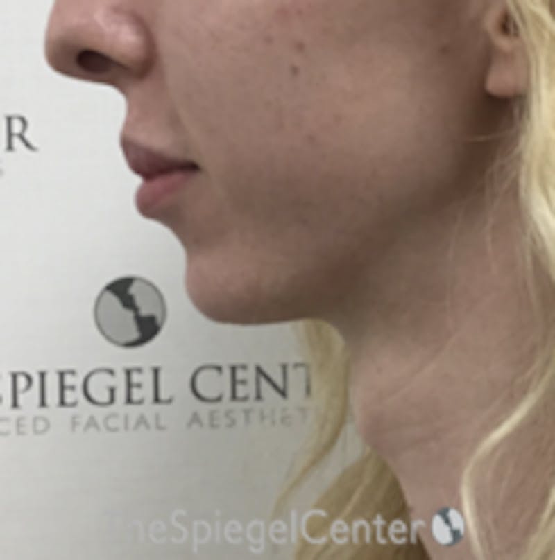 Trachea Shave Before & After Gallery - Patient 157140086 - Image 1