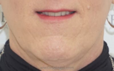 Mandible Contouring Before & After Gallery - Patient 157140084 - Image 1